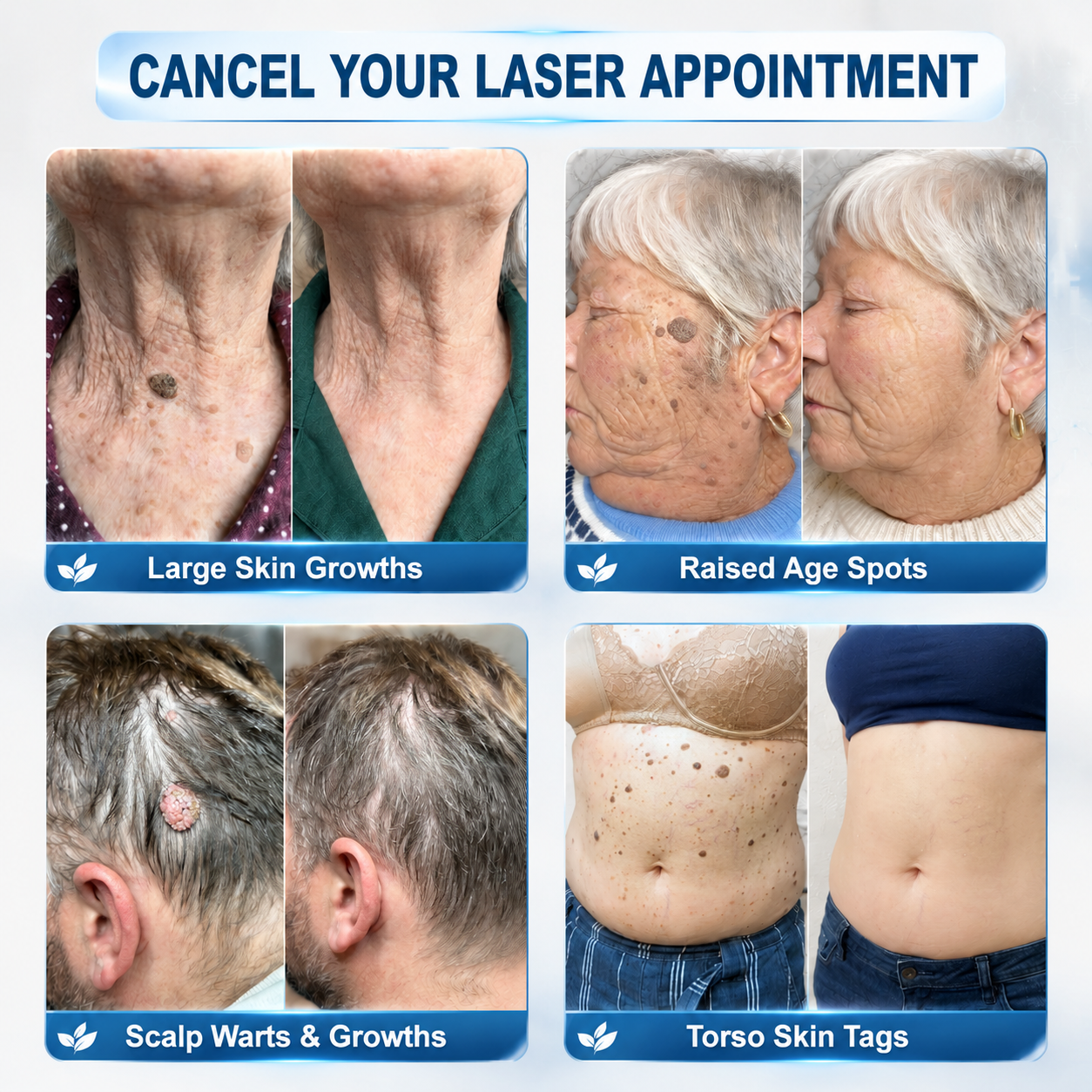 𝐇𝐈𝐒𝐊𝐈𝐍®👩‍⚕️👩‍⚕️𝟕-𝐃𝒂𝘆 𝐒𝗸𝐢𝐧 𝐓𝒂𝗴 & 𝐒𝐩𝙤𝐭 𝐄𝐫𝒂𝐬𝙚𝐫 Painless & Scar-Free Advanced Imperfection Removal Rollerball Pen