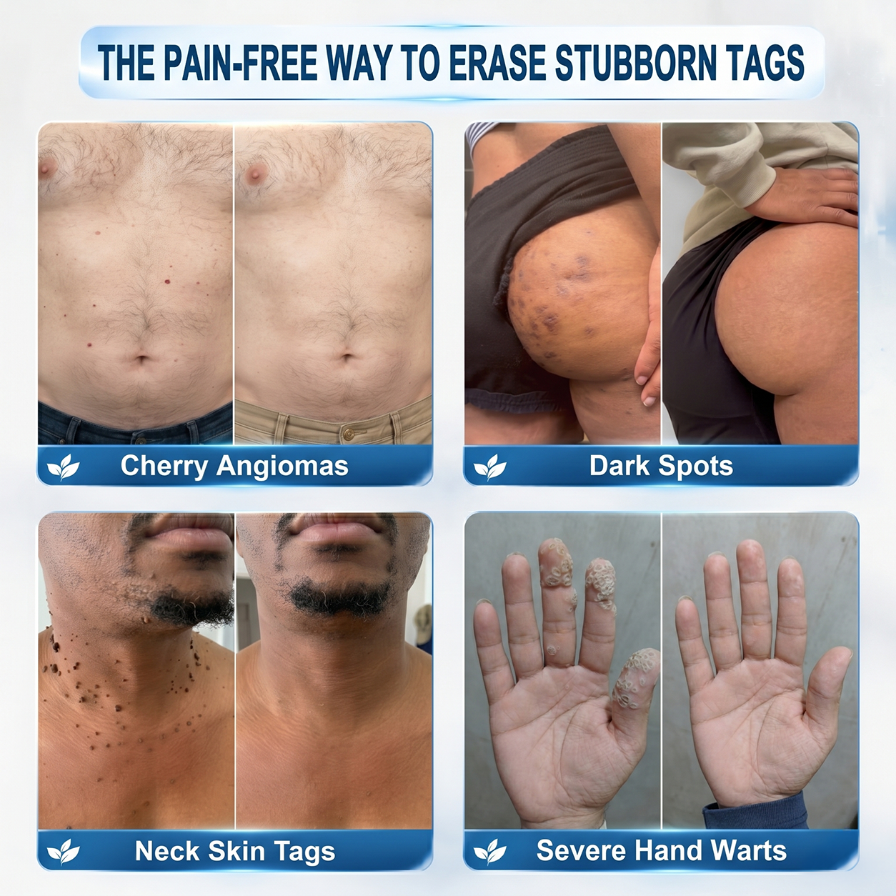 𝐇𝐈𝐒𝐊𝐈𝐍®👩‍⚕️👩‍⚕️𝟕-𝐃𝒂𝘆 𝐒𝗸𝐢𝐧 𝐓𝒂𝗴 & 𝐒𝐩𝙤𝐭 𝐄𝐫𝒂𝐬𝙚𝐫 Painless & Scar-Free Advanced Imperfection Removal Rollerball Pen