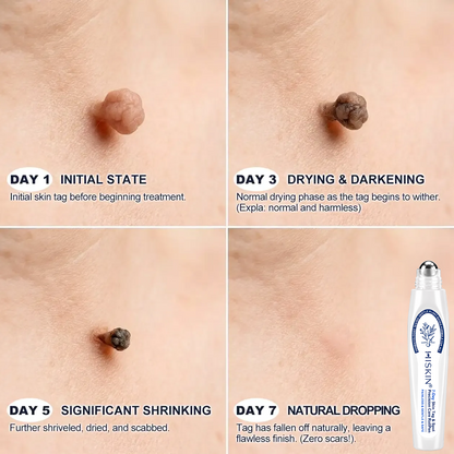 𝐇𝐈𝐒𝐊𝐈𝐍®👩‍⚕️👩‍⚕️𝟕-𝐃𝒂𝘆 𝐒𝗸𝐢𝐧 𝐓𝒂𝗴 & 𝐒𝐩𝙤𝐭 𝐄𝐫𝒂𝐬𝙚𝐫 Painless & Scar-Free Advanced Imperfection Removal Rollerball Pen