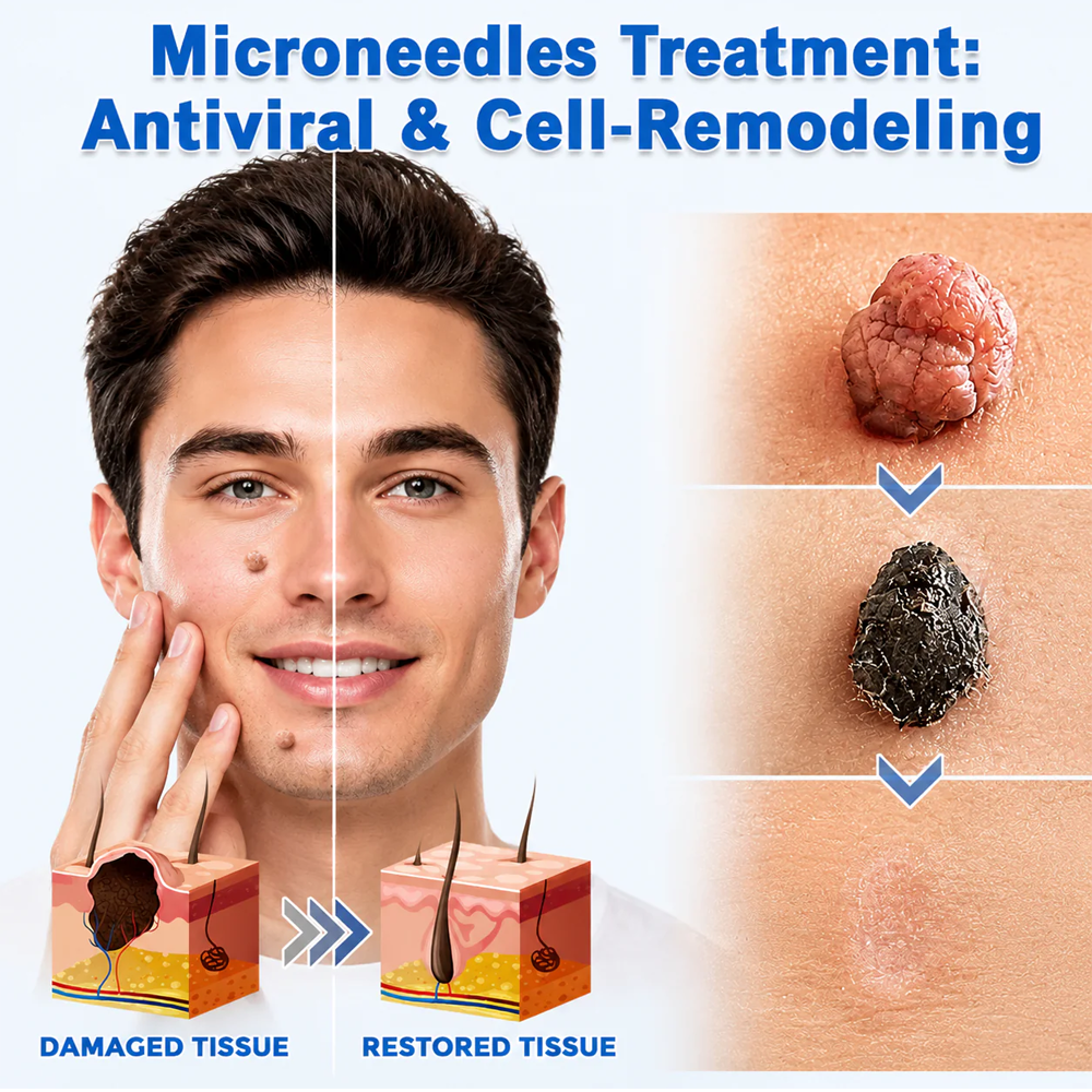 🎉𝑯𝒊𝒔𝒌𝒊𝒏® 2-in-1 Microneedle & Hydrocolloid Patch | Removes raised moles, acne, flat warts, and skin tags | Helps improve wrinkles, scars, and blemishes | Invisible patches for face and body