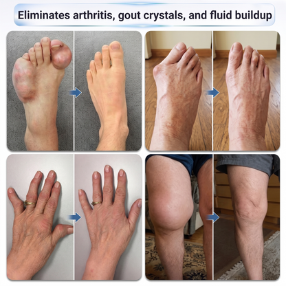𝑿𝑹𝑳𝑿𝑹𝑳® 0.05mm Microneedle Bone & Joint Recovery Roller 🧑‍⚕️(For All Adults, Men & Women – Comprehensive Care for Multiple Joint Concerns)