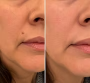 🎉𝑯𝒊𝒔𝒌𝒊𝒏® 2-in-1 Microneedle & Hydrocolloid Patch | Removes raised moles, acne, flat warts, and skin tags | Helps improve wrinkles, scars, and blemishes | Invisible patches for face and body