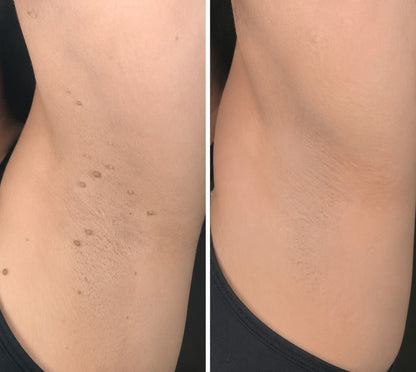 🎉𝑯𝒊𝒔𝒌𝒊𝒏® 2-in-1 Microneedle & Hydrocolloid Patch | Removes raised moles, acne, flat warts, and skin tags | Helps improve wrinkles, scars, and blemishes | Invisible patches for face and body