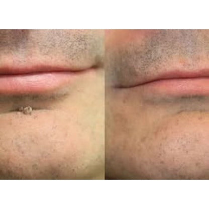 🎉𝑯𝒊𝒔𝒌𝒊𝒏® 2-in-1 Microneedle & Hydrocolloid Patch | Removes raised moles, acne, flat warts, and skin tags | Helps improve wrinkles, scars, and blemishes | Invisible patches for face and body