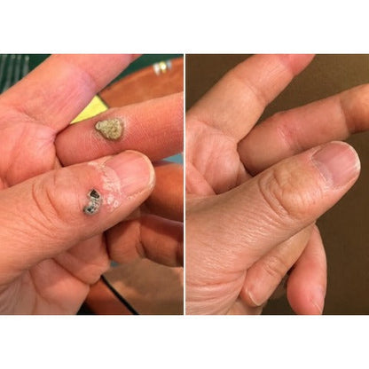 🎉𝑯𝒊𝒔𝒌𝒊𝒏® 2-in-1 Microneedle & Hydrocolloid Patch | Removes raised moles, acne, flat warts, and skin tags | Helps improve wrinkles, scars, and blemishes | Invisible patches for face and body