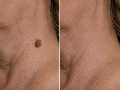 🎉𝑯𝒊𝒔𝒌𝒊𝒏® 2-in-1 Microneedle & Hydrocolloid Patch | Removes raised moles, acne, flat warts, and skin tags | Helps improve wrinkles, scars, and blemishes | Invisible patches for face and body