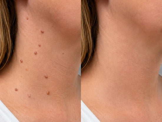 🎉𝑯𝒊𝒔𝒌𝒊𝒏® 2-in-1 Microneedle & Hydrocolloid Patch | Removes raised moles, acne, flat warts, and skin tags | Helps improve wrinkles, scars, and blemishes | Invisible patches for face and body