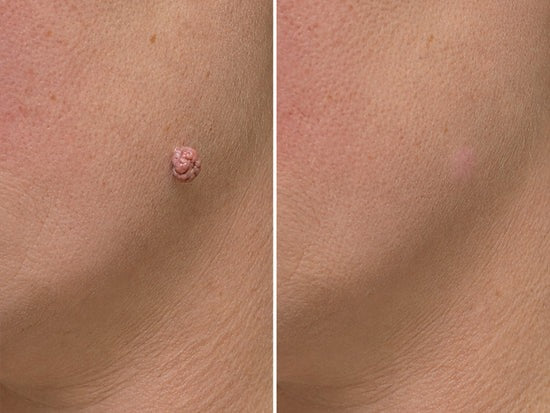🎉𝑯𝒊𝒔𝒌𝒊𝒏® 2-in-1 Microneedle & Hydrocolloid Patch | Removes raised moles, acne, flat warts, and skin tags | Helps improve wrinkles, scars, and blemishes | Invisible patches for face and body